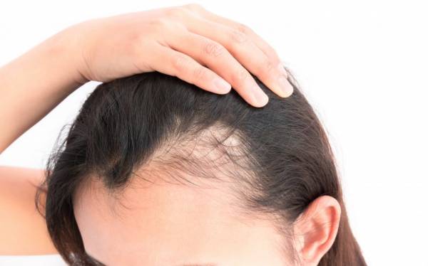 علت های ریزش مو