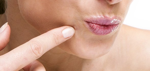 درمان های خانگی برای زگیل