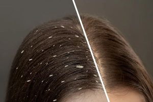 Hair lice prevention