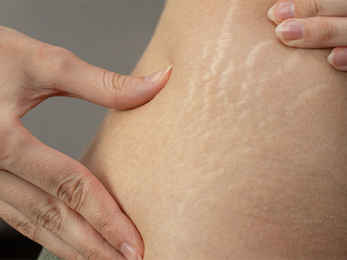 Stretch Marks